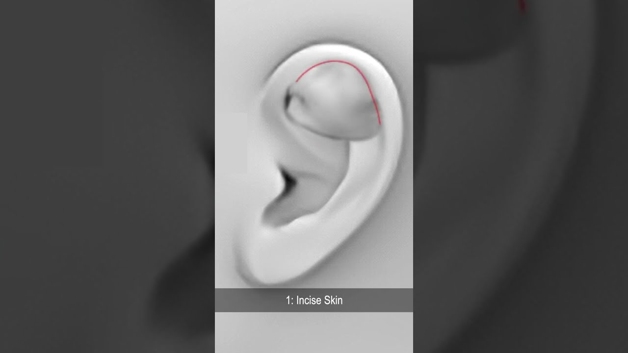 Auricular Hematoma Treatment to Prevent Cauliflower Ear 