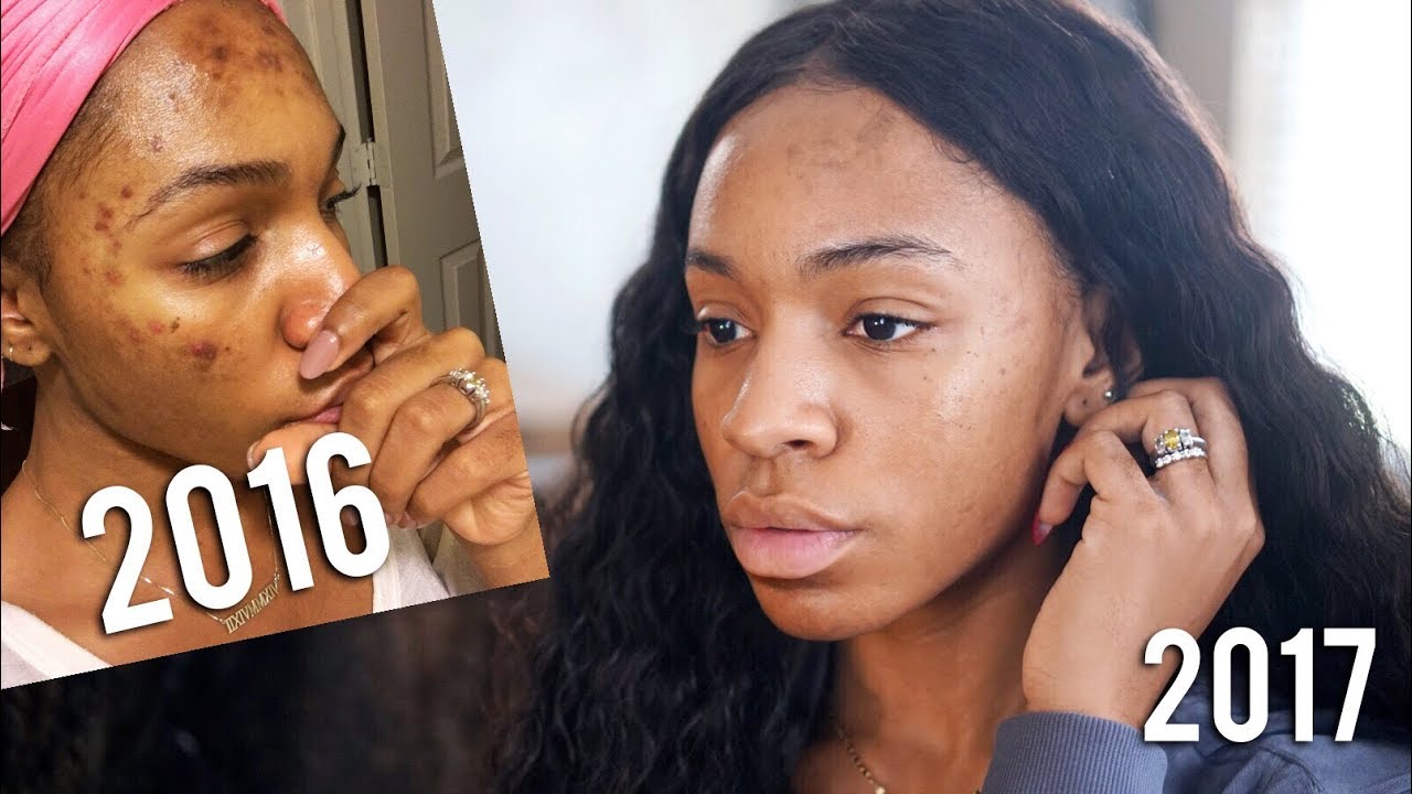 HOW I CLEARED MY SKIN! Skincare Routine + Fav Products for Dark Spots, Pores, Texture ▸ VICKYLOGAN
