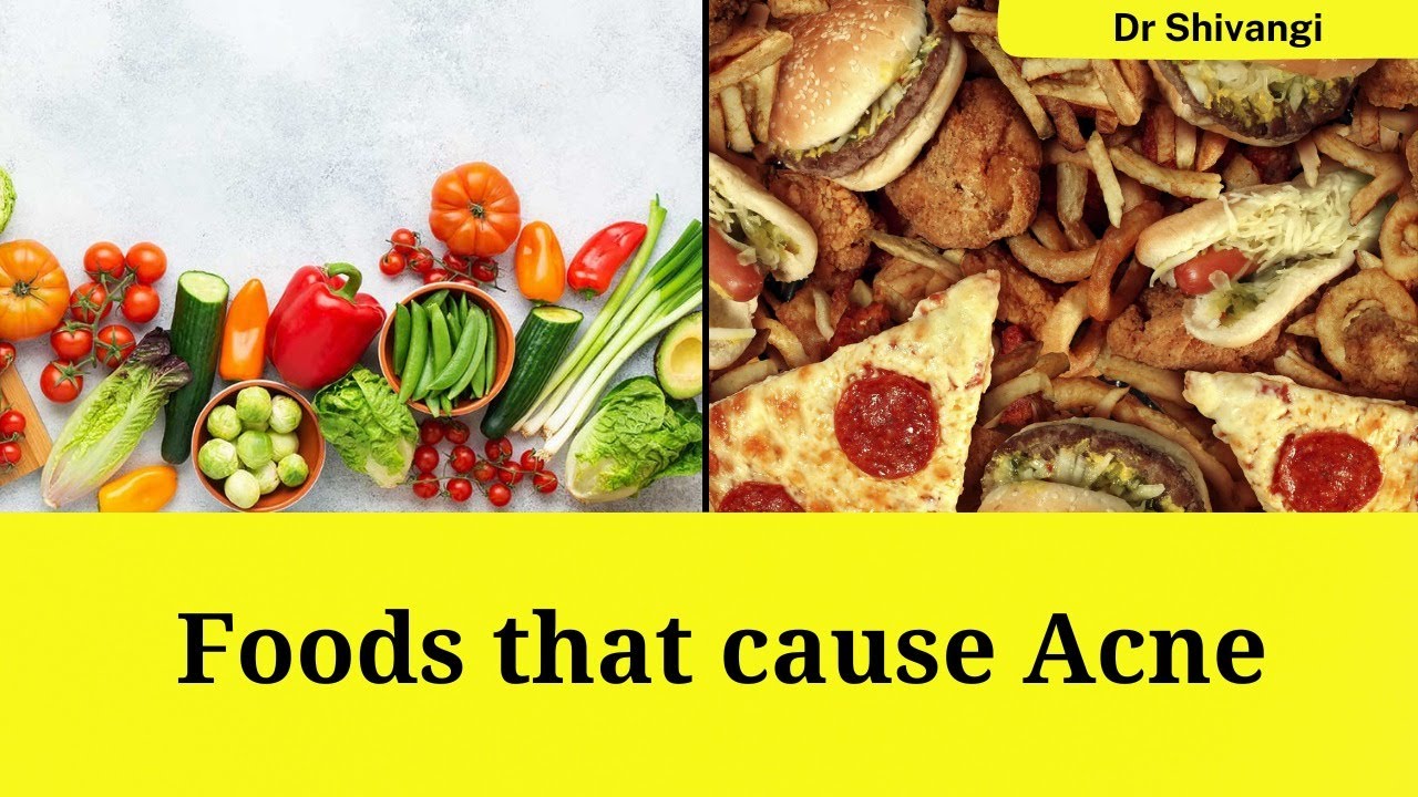 Top 7 Foods That Can Cause Acne