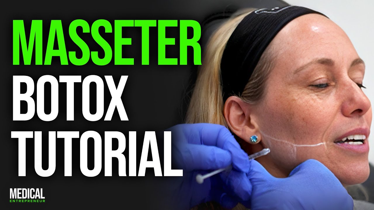 Masseter Botox for Facial Slimming and Migraines | Full Procedure Demonstration