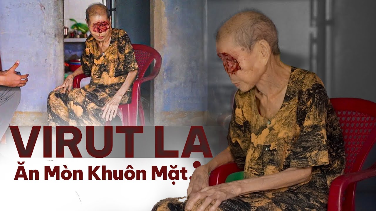 Bà Lão Bị Virut Lạ Ăn Mòn Khuôn Mặt Sự Sống Rất Mong Manh
