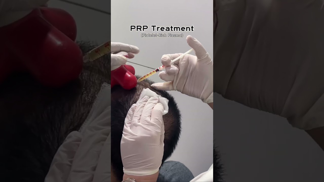 Unlock the Secrets of Hair PRP! 🌟  #berkowits #PRP