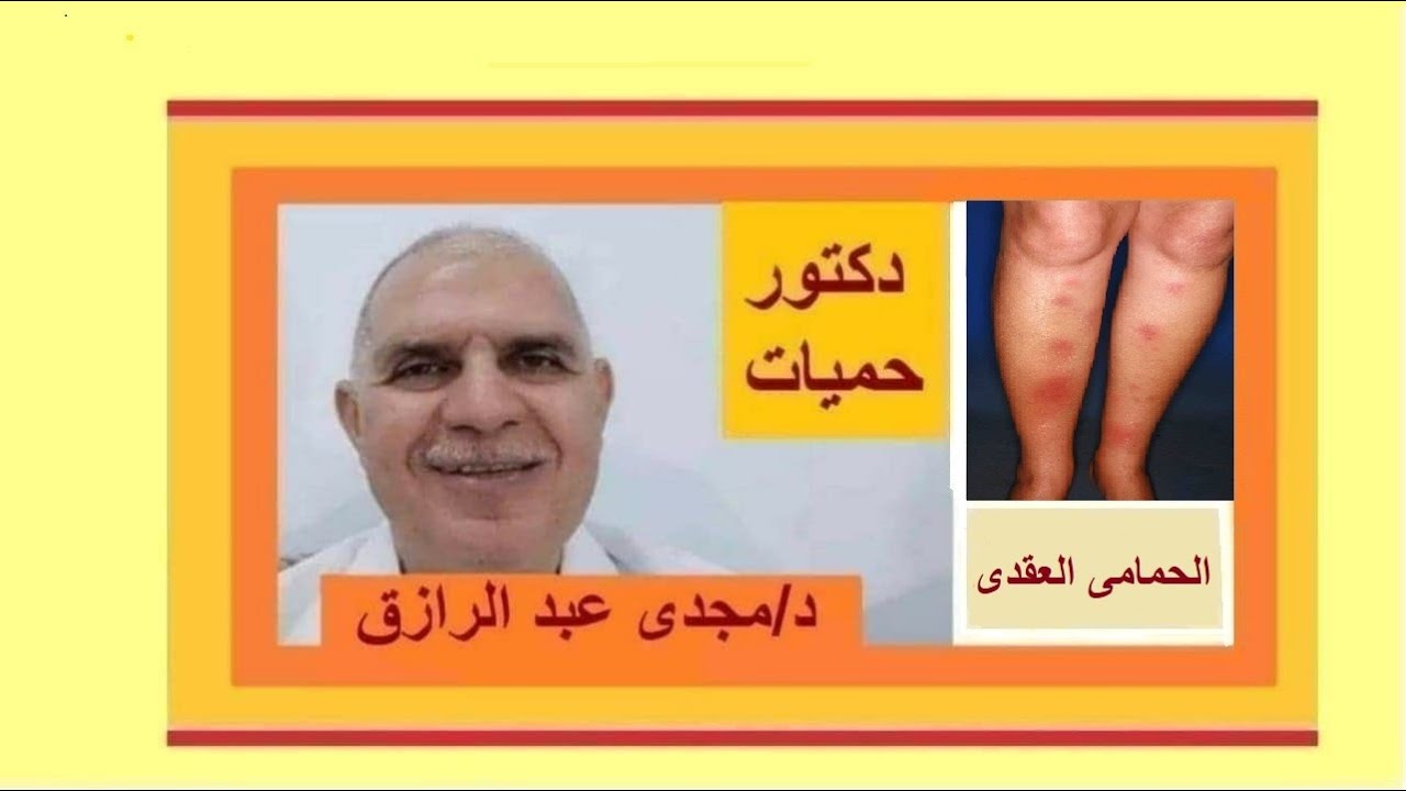 Лечение узловатой эритемы