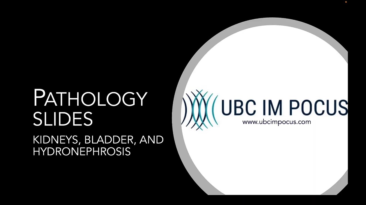 POCUS Pathology: Kidneys, Bladder, and Hydronephrosis