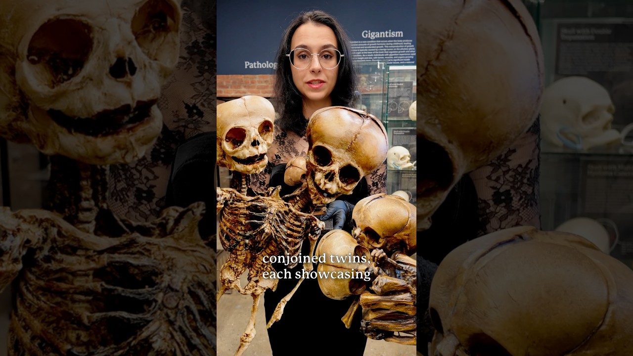 Сиамские близнецы: объяснение. Наука о сиамских близнецах. Почему сиамские близнецы срастаются