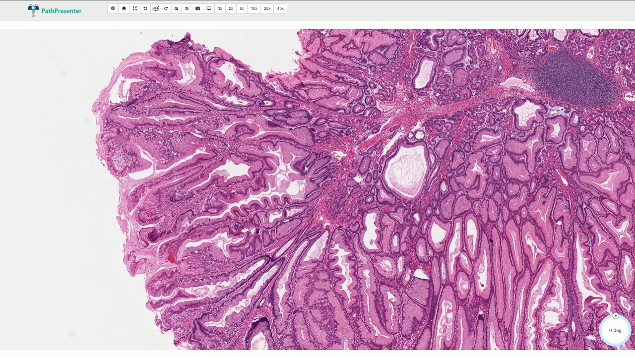 Peutz-Jeghers Polyp - Histopathology