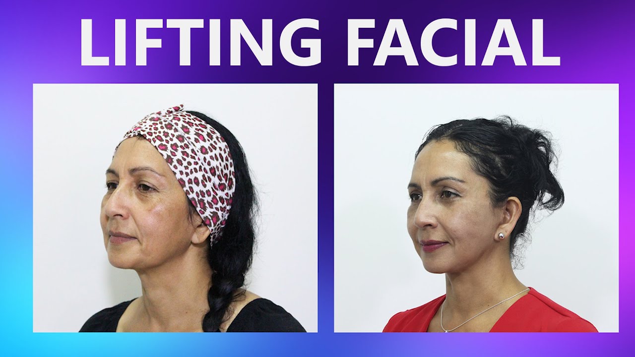 REJUVENECIMIENTO FACIAL + BLEFAROPLASTÍA 👸 LIFTING FACIAL ANTES y DESPUES 💕DR PERCY NEVADO ALBÁN