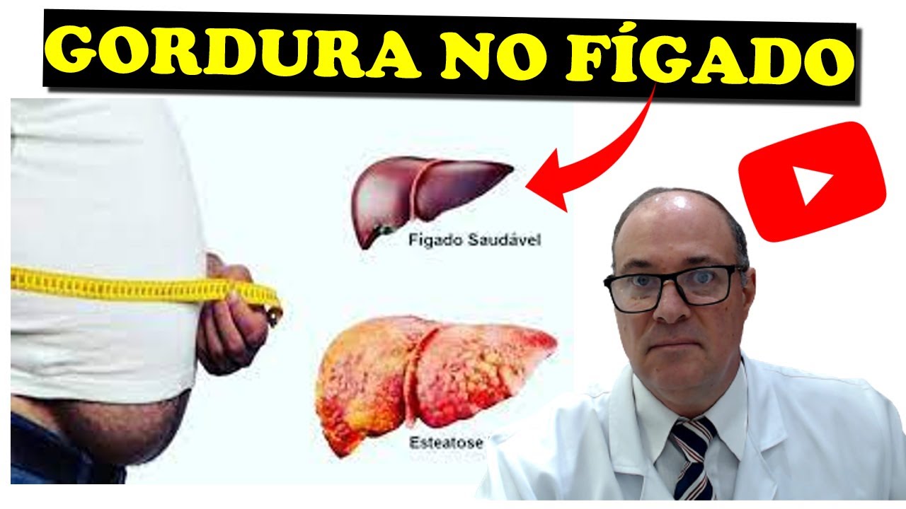 COMO REVERTER E TRATAR A ESTEATOSE HEPÁTICA ( GORDURA NO FIGADO )