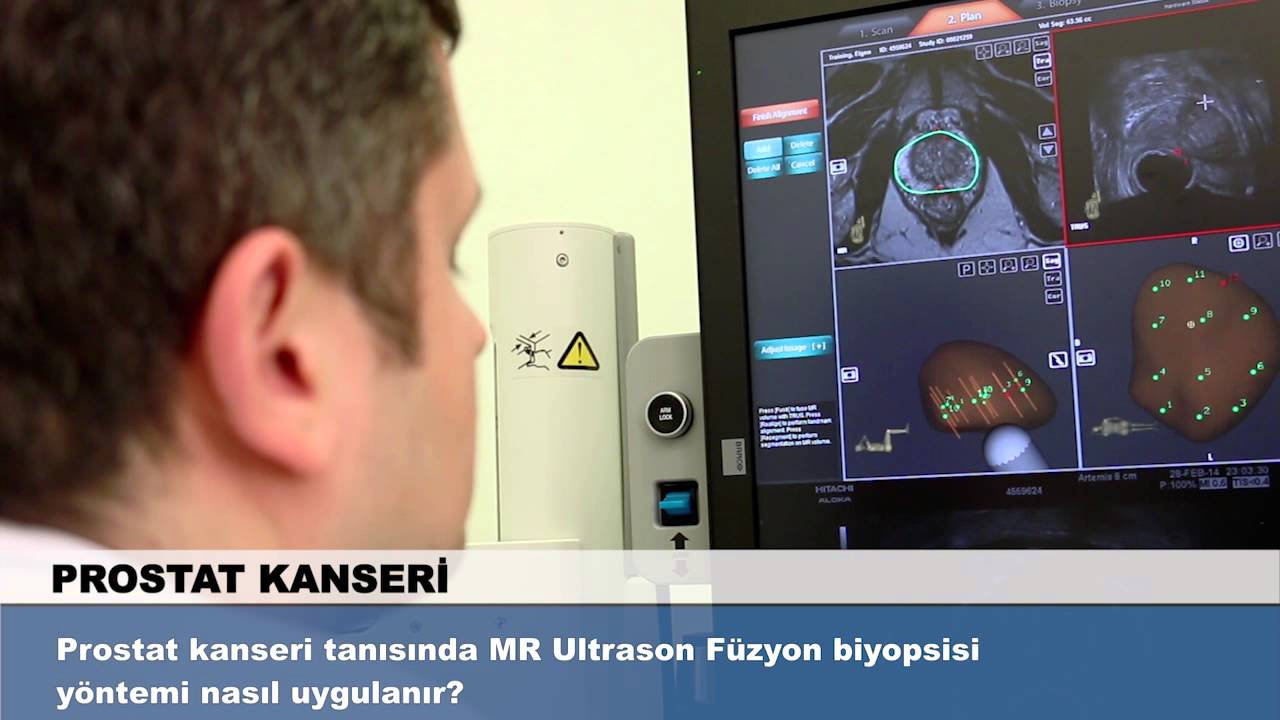 Prostat kanseri tanısında MR Ultrason Füzyon biyopsisi yöntemi nasıl uygulanır?