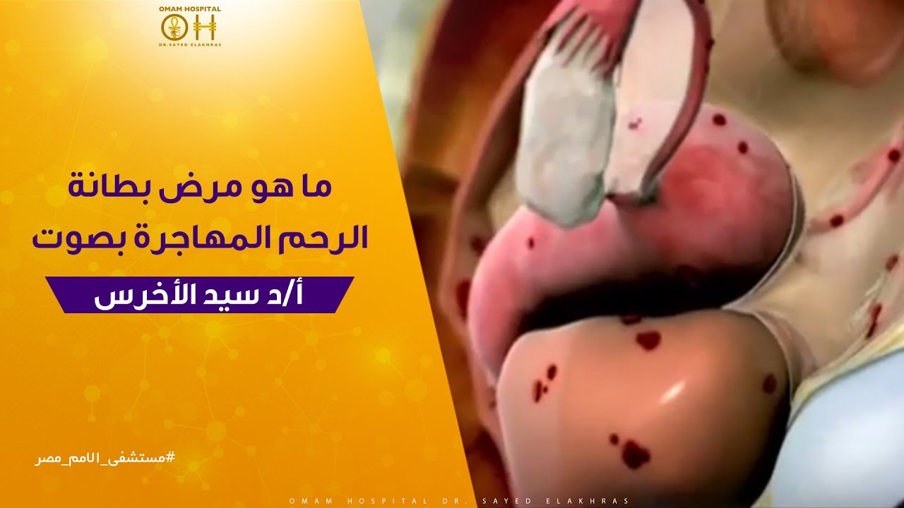 ما هو مرض بطانة الرحم المهاجرة بصوت دكتور سيد الأخرس
