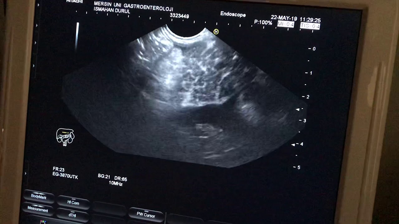 Endoskopik ultrasonografi ( Eus ) , kronik pankreatit ve pankreasta bal peteği görünümü