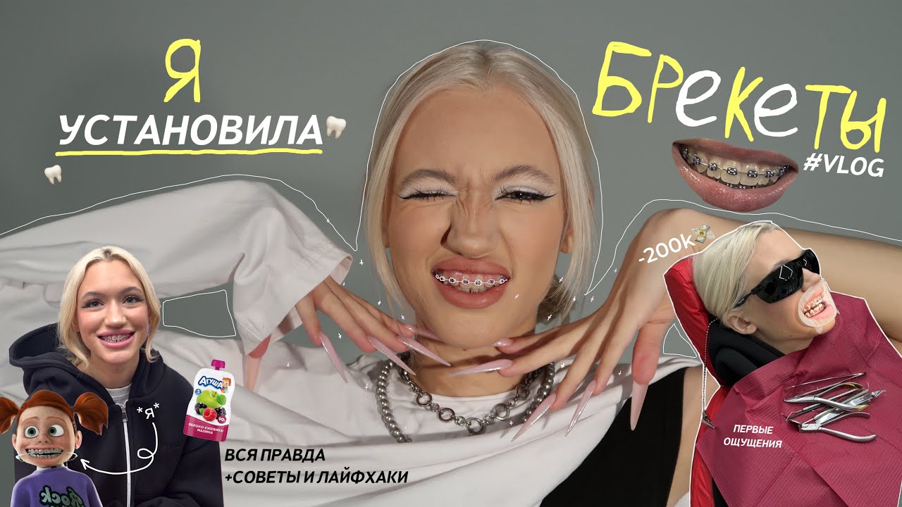 VLOG: Я ПОСТАВИЛА БРЕКЕТЫ! *первые ощущения* первый месяц с ними…