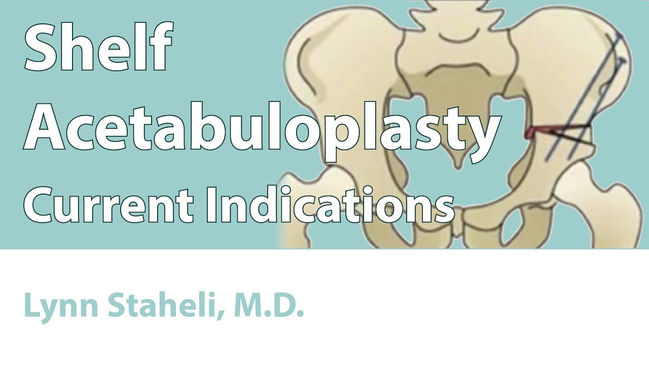 Shelf Acetabuloplasty (Current Indications)