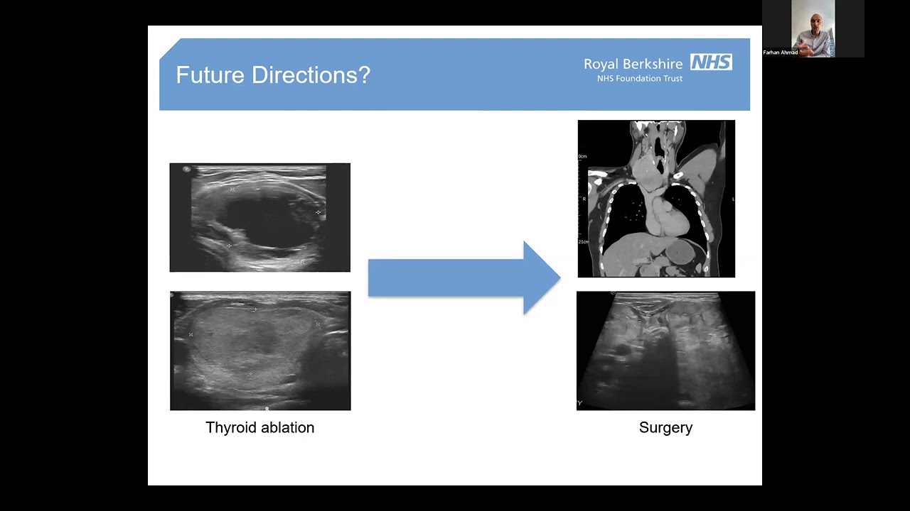 Meet the Experts webinar on non-surgical treatments for benign thyroid nodules