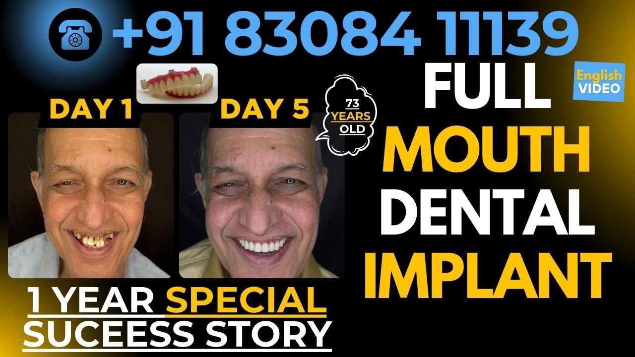 Full Mouth Dental Implant 1-Year Success Story | Dr. Mayur Khairnar | PreciGem Dental
