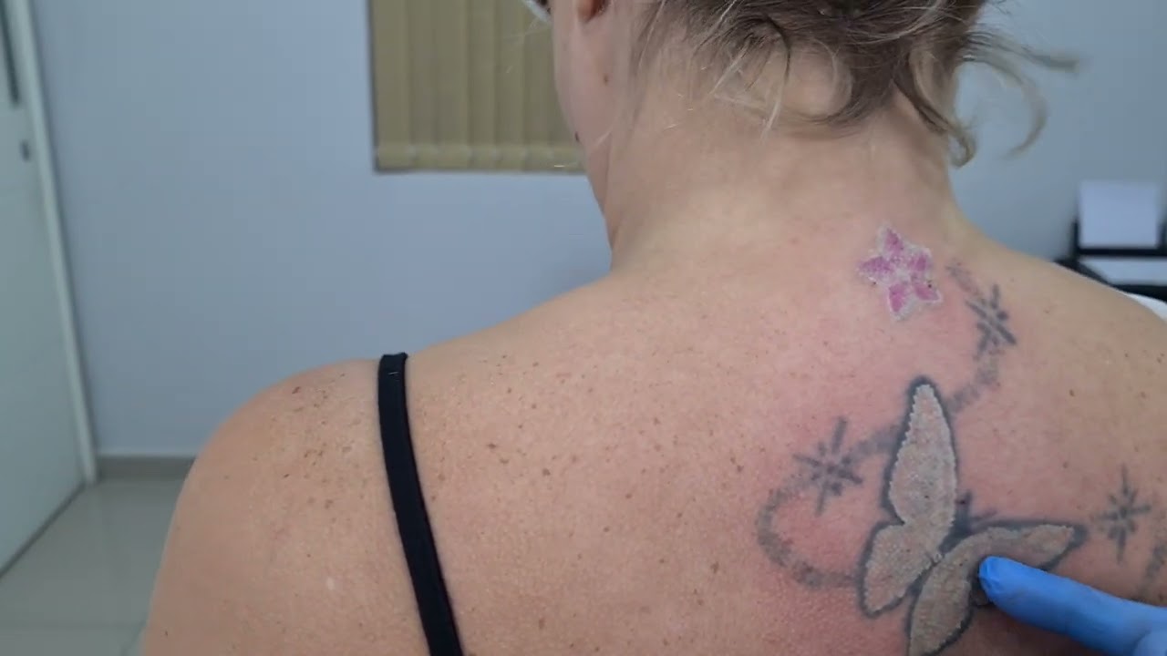 Remoção de Tatuagem colorida com laser PicoSure e outros lasers associados , Spectra e Co2 Fracionad
