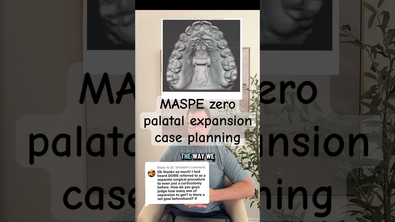 MASPE zero palatal expansion case planning #maspezero #maspe #marpe #palatalexpansion