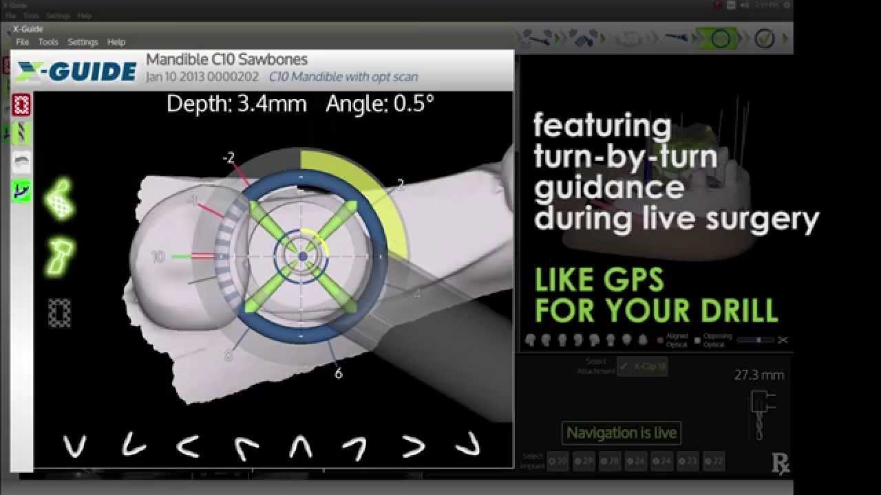 Intro Demo for the X-Guide Dynamic 3D Navigation System