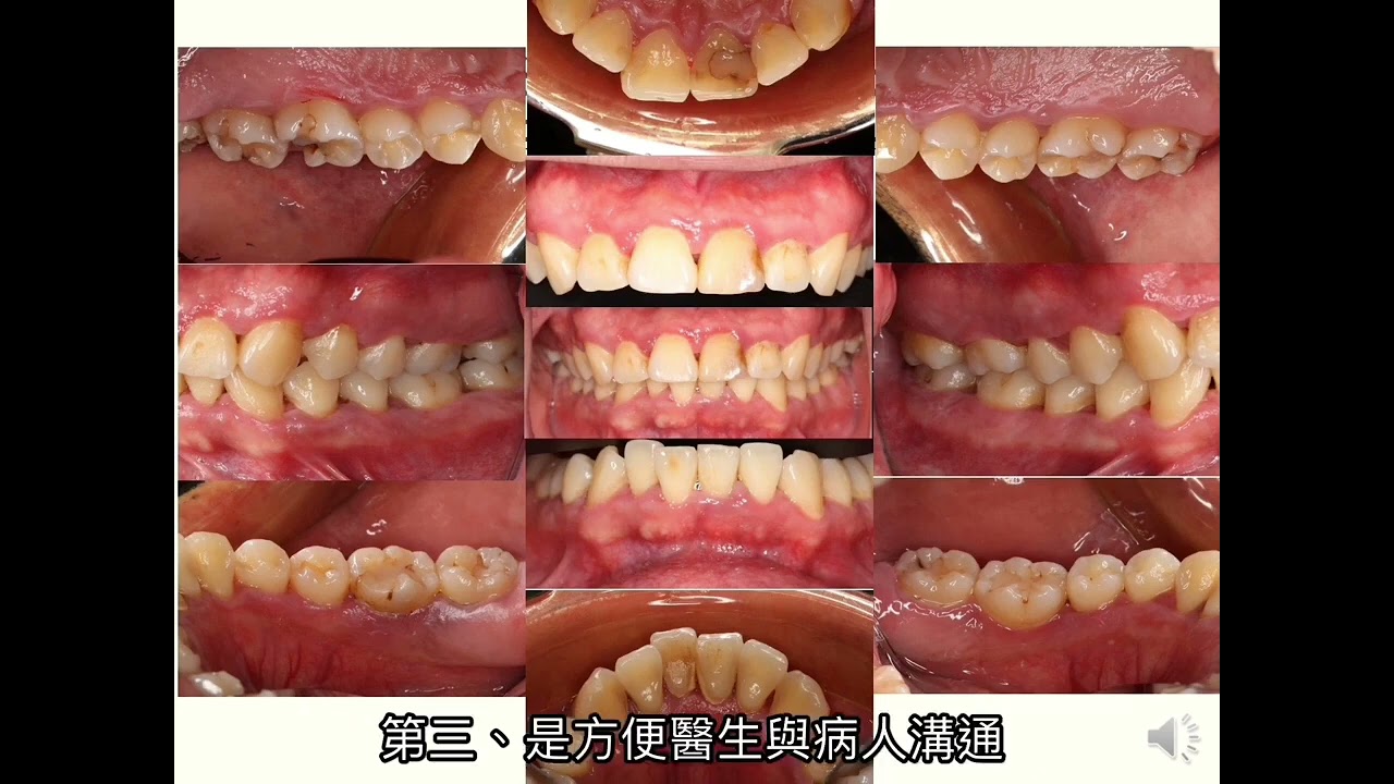牙周病- 牙周治療大解析---三軍總醫院牙周病科