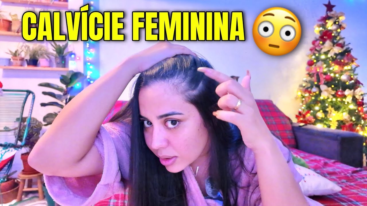 Descobri que tenho CALVÍCIE e vou precisar tratar com MINOXIDIL ORAL 😢 Alopecia Androgenética