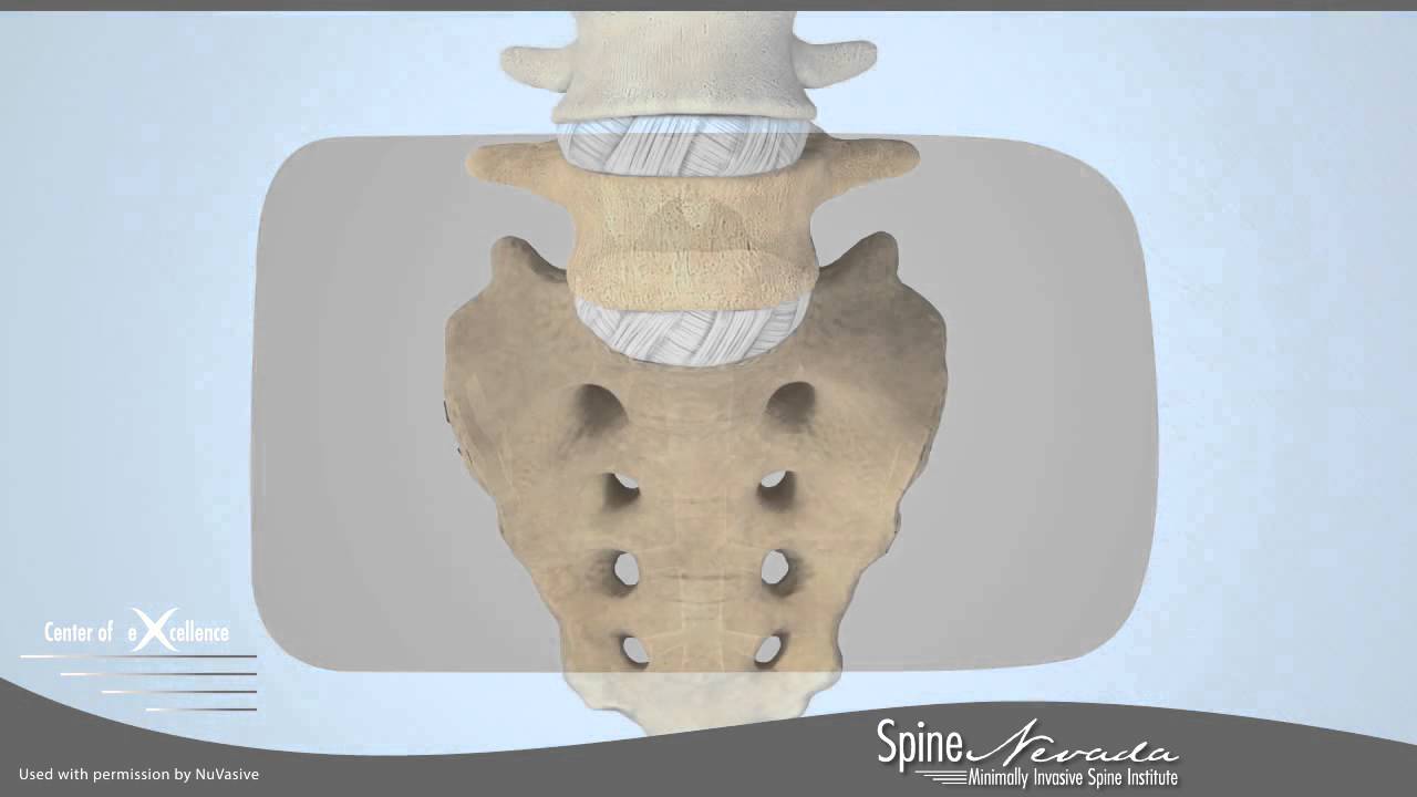 Minimally Invasive Anterior Lumbar Interbody Fusion - Reno, Sparks, Carson, Northern Nevada