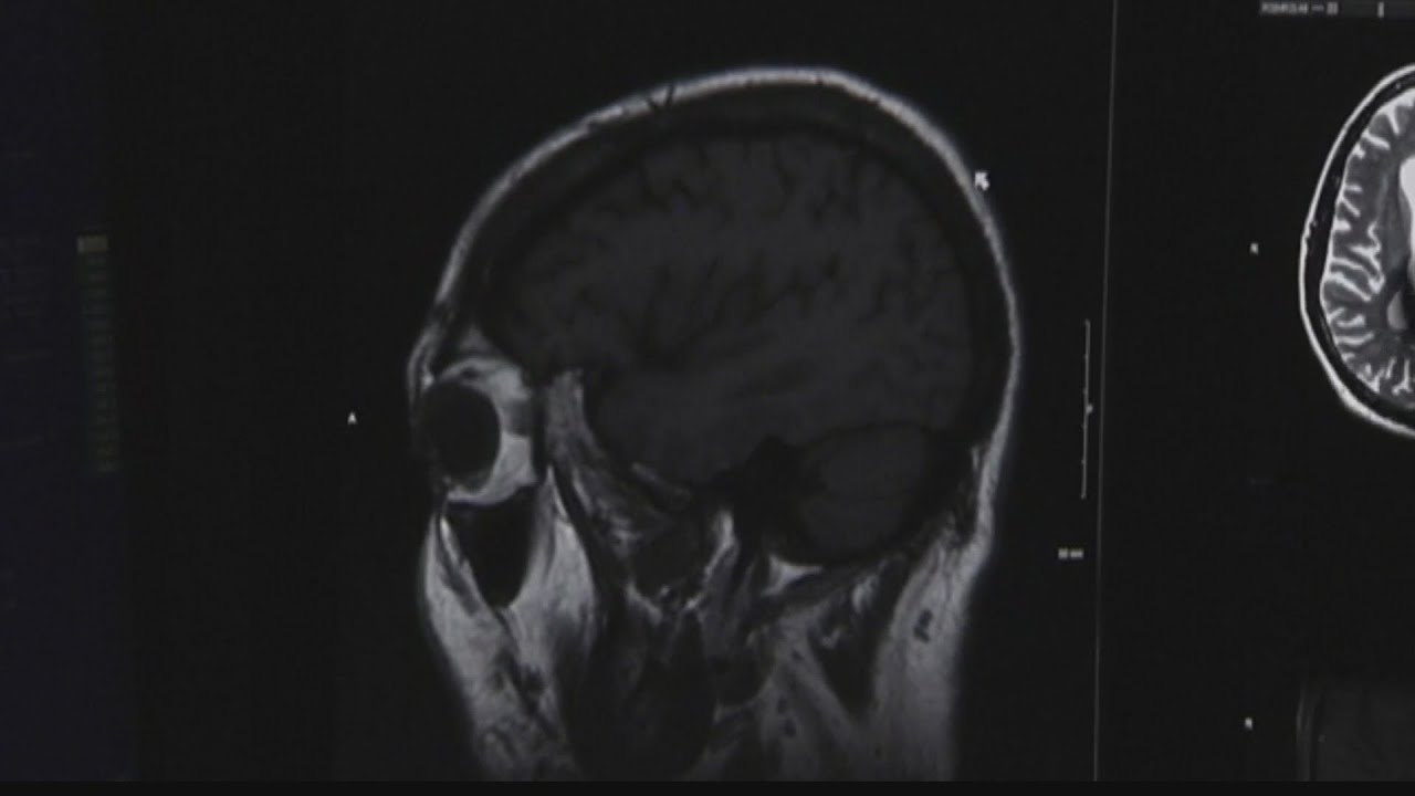 Sexual Assault brain damage research