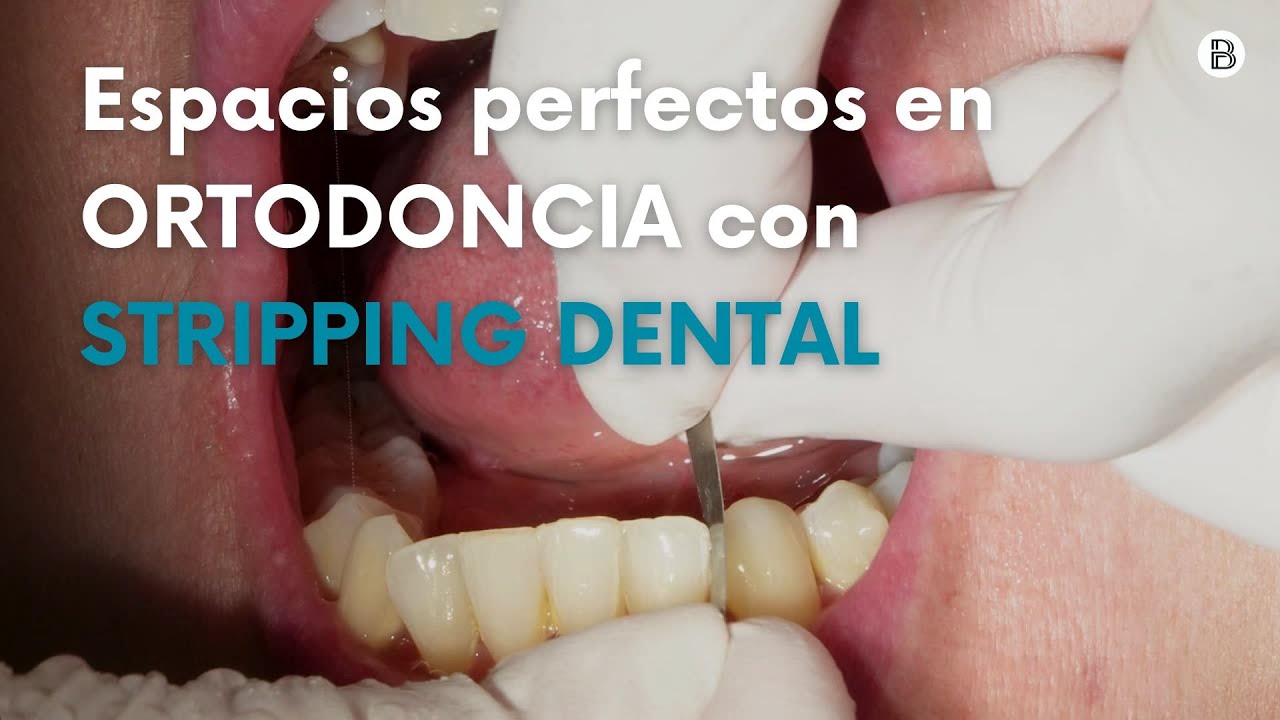 Stripping Dental: Todo lo que Necesitas Saber | Técnica Paso a Paso