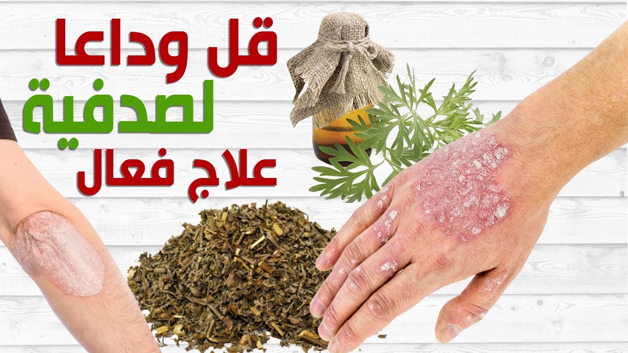 الصدفية: احدث علاجات الصدفية، وما هي اعراضها، ربما يكون الحل أسهل