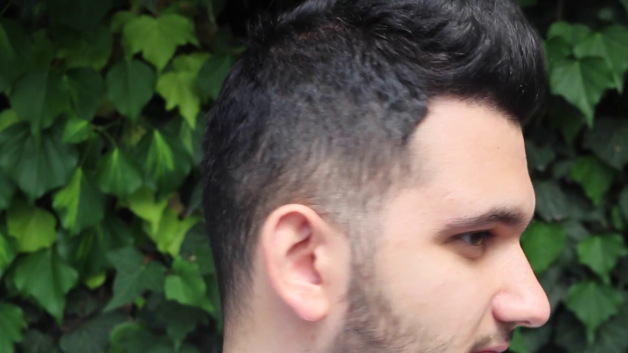 Hair Transplant Result with 3400 Grafts, Dense Packing! Excellent Result!