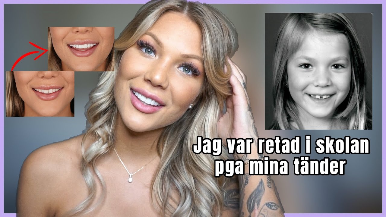 Svarar på frågor om mina tandfasader! Pris? Gjorde det ont?