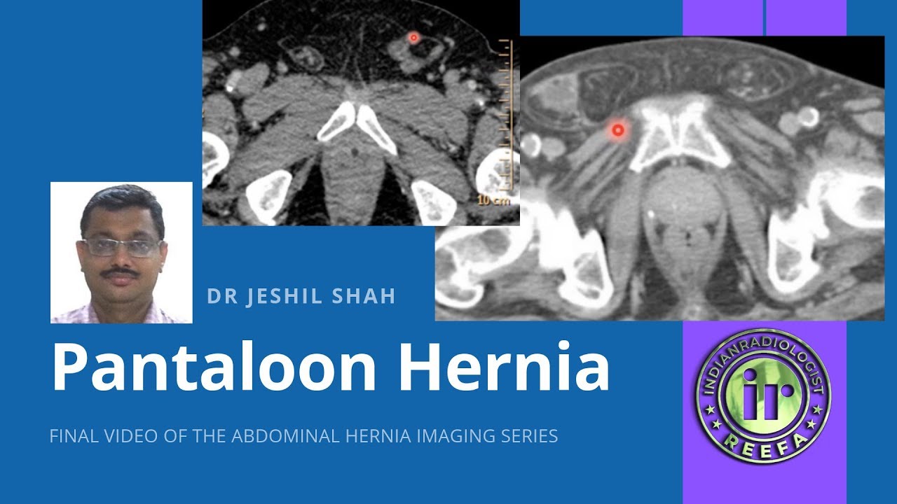 TMT: Pantaloon Hernia by Dr Jeshil Shah