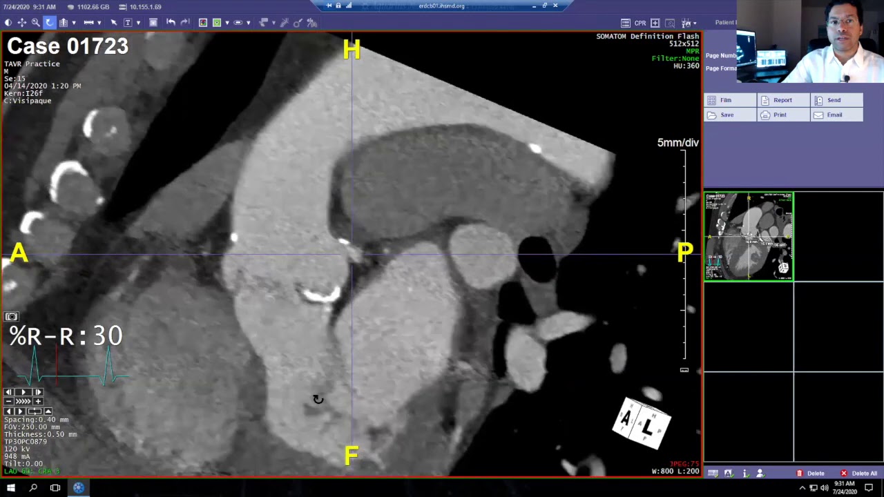 Cardiac CT for TAVR