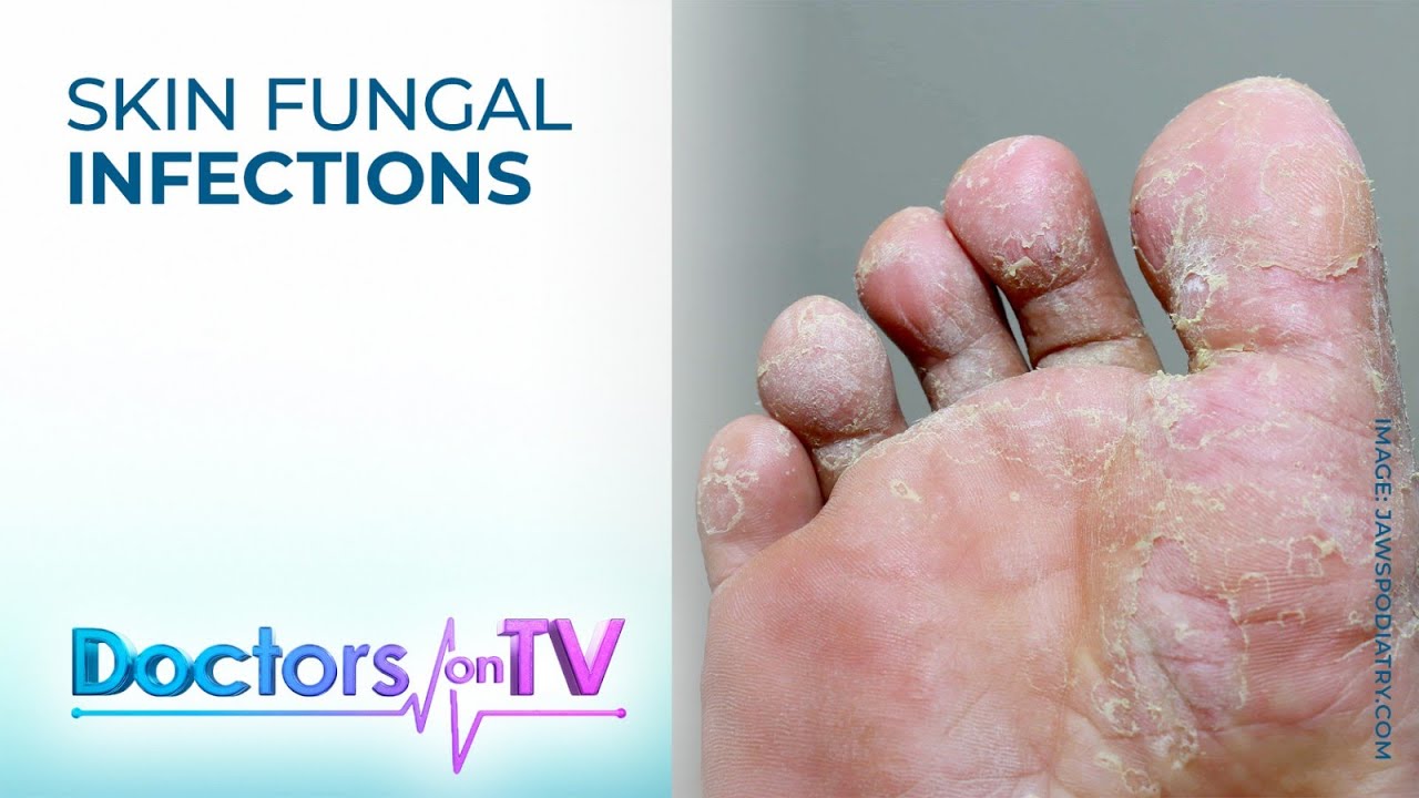 Fight Skin Fungal Infections During Rainy Season | Doctors on TV