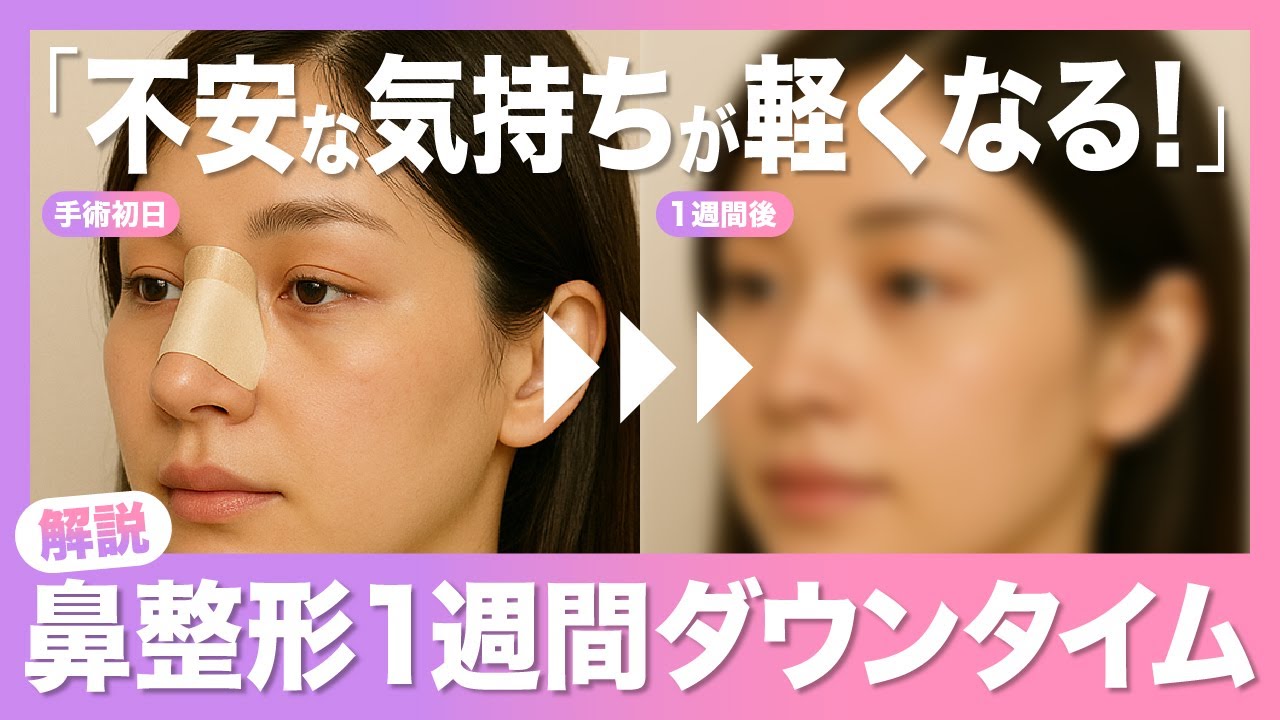 【触るのは絶対NG】鼻整形1週間のリアル｜術後の不安解消＆ツラい瞬間まとめ