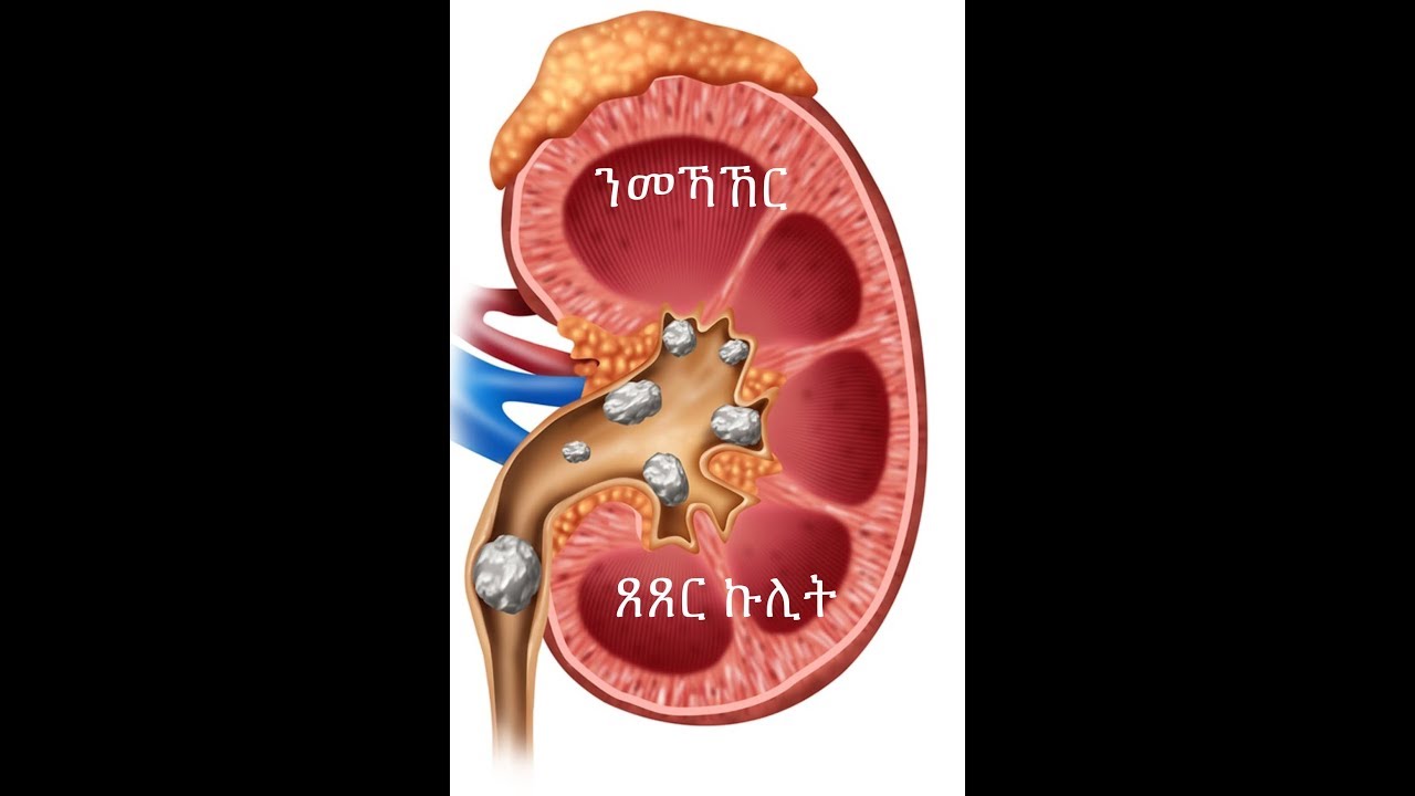 ጸጸር ኩሊት: ጠንቅታቱን ምክልኻሉን።