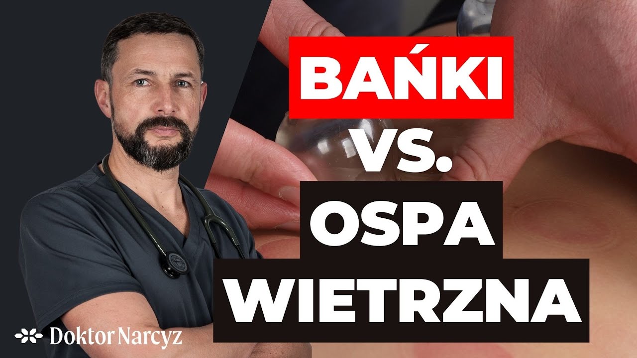 Czy ospę wietrzną można leczyć bańkami?