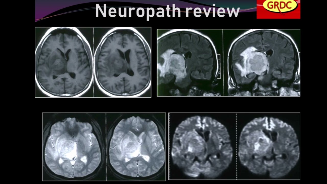 Tumour mimics in Brain 
