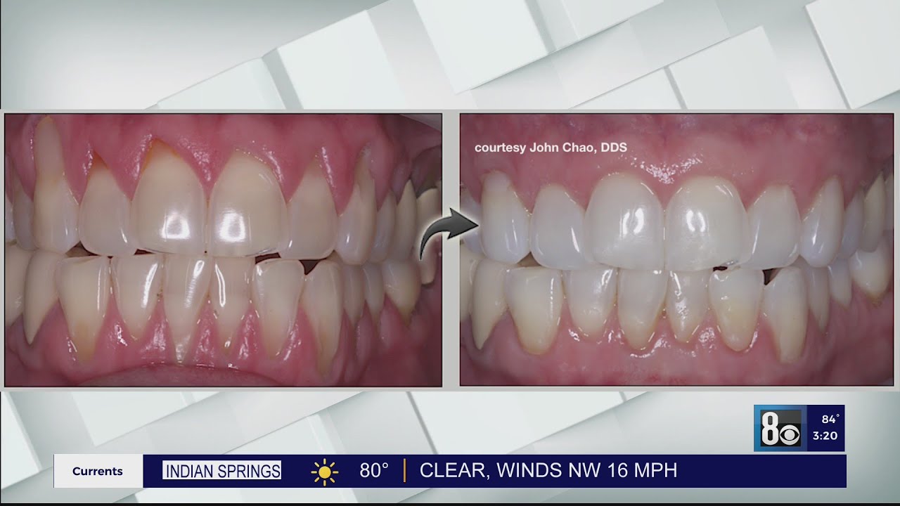 An easier fix for receding gums