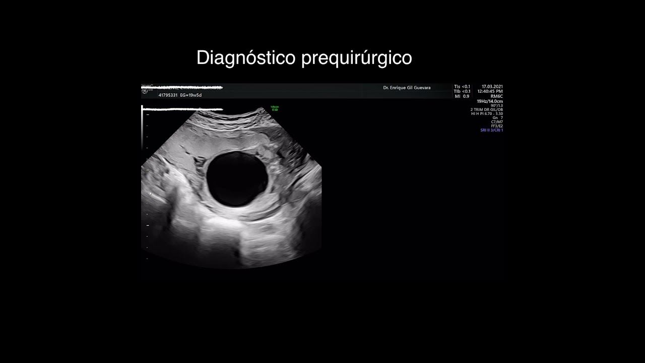 LUTO Vesicoamniotic Shunting for PUV