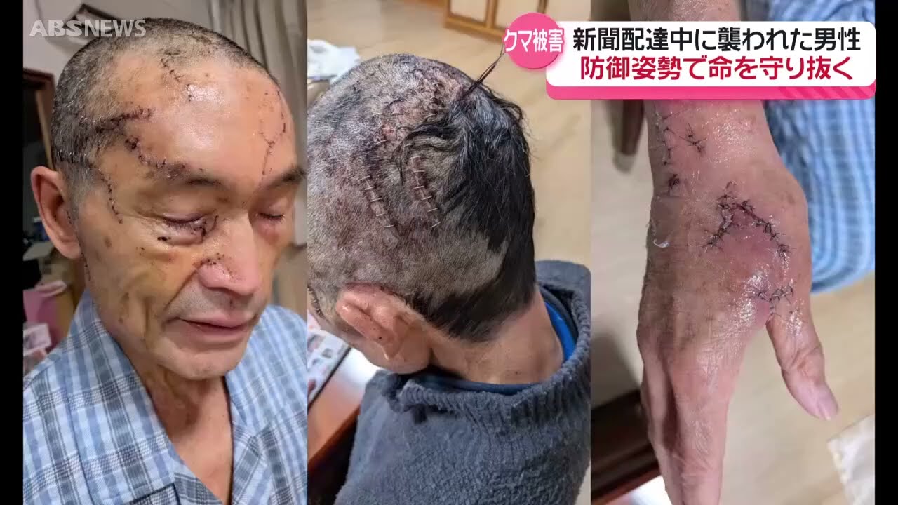 【特集】クマに襲われた人たちの証言「命に別条無くても結構なケガ」