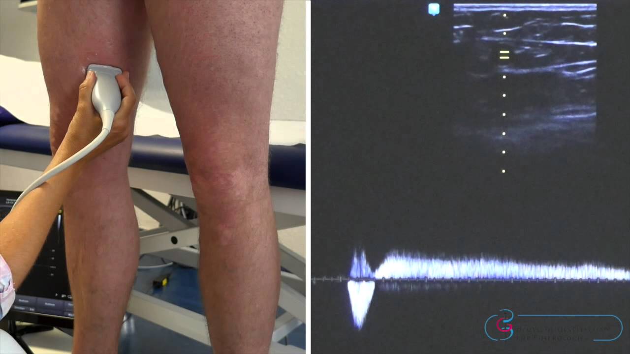 Krampfadern: Diagnostik mit Ultraschall 2