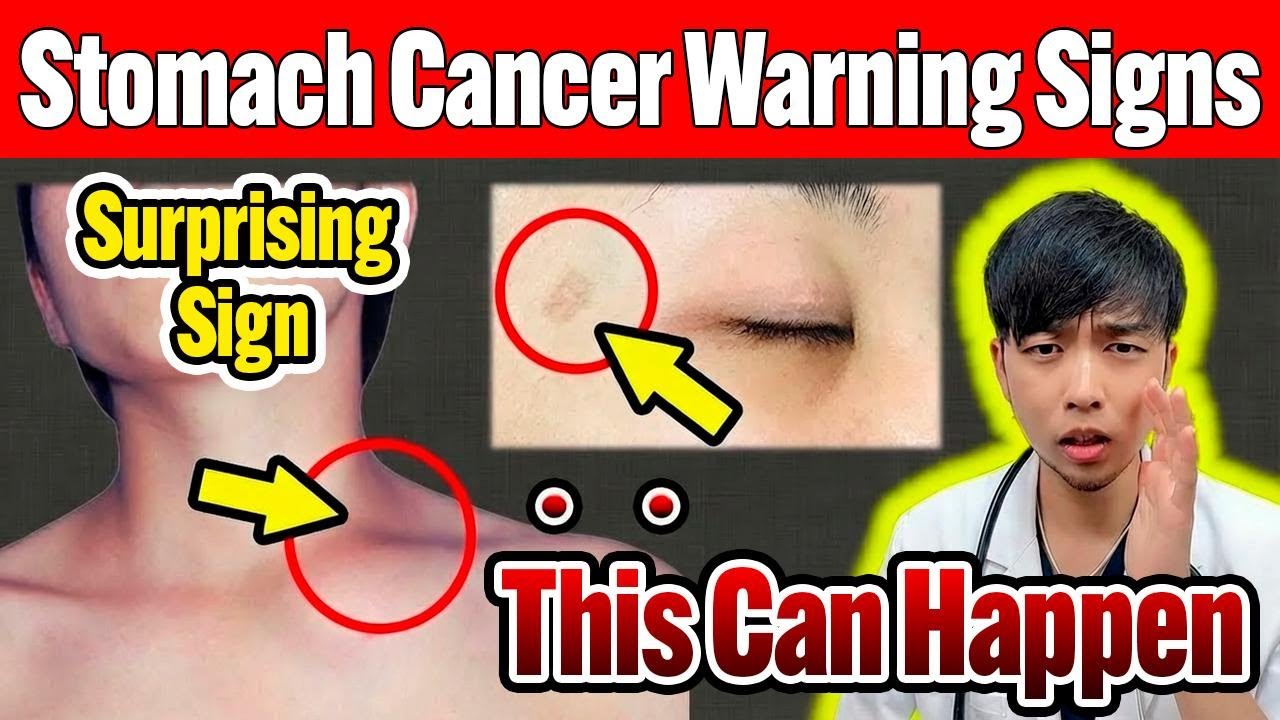 5 Skin Changes That Could Signal Stomach Cancer—A Doctor Explains Surprising Symptoms