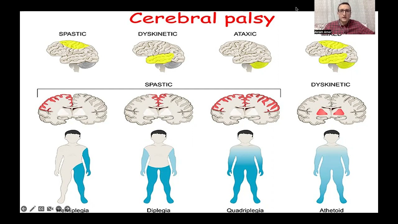 Anesthesia for Pediatric patients with Cerebral Palsy (CP), Part-1