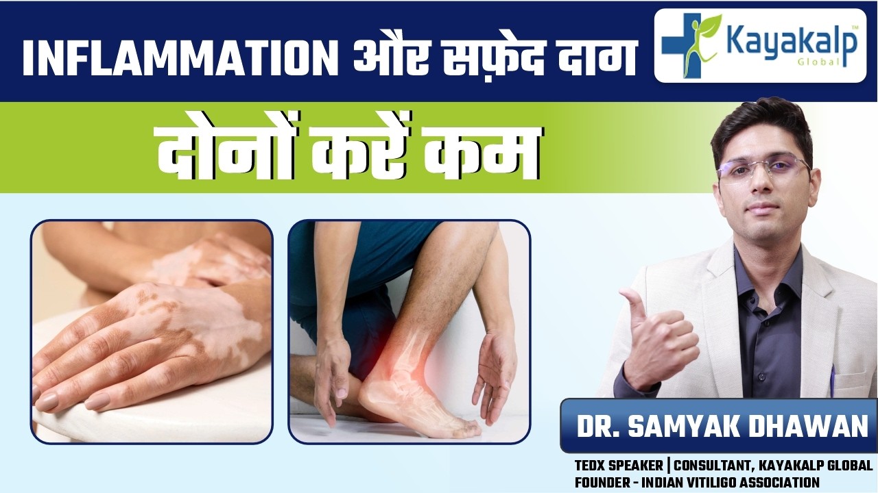 सफ़ेद दाग को फैलने से कैसे रोकें? | Best Morning Ritual to Stop Vitiligo Spreading | Kayakalp Global