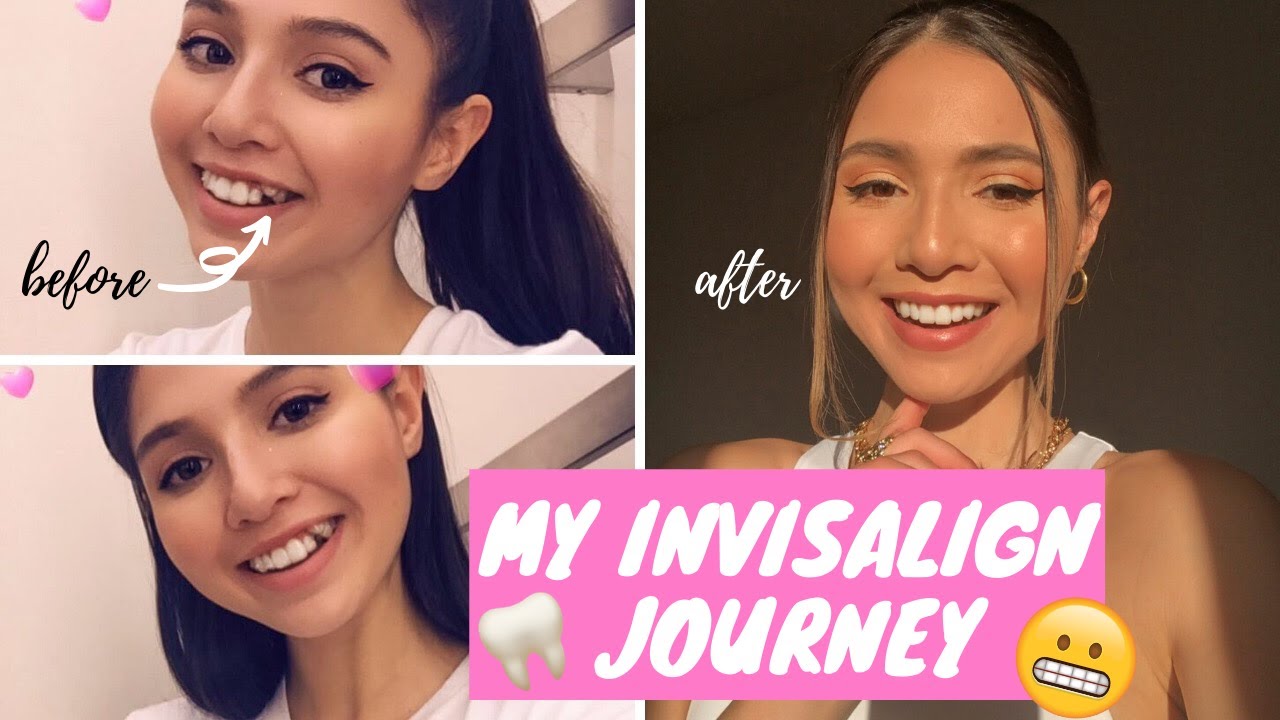 I HAD INVISALIGN FOR 2+ YEARS - do I regret it, what I wish I knew BEFORE (tips)...