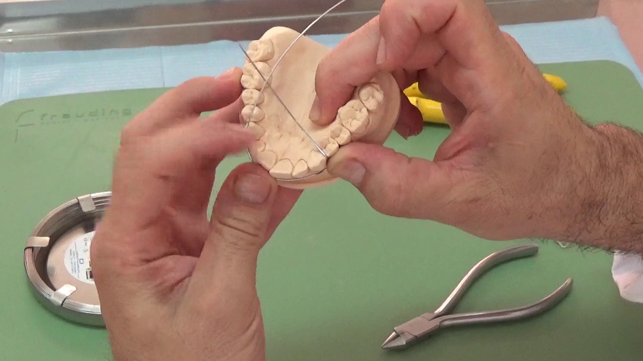 Realización Arco vestibular ortodoncia removible