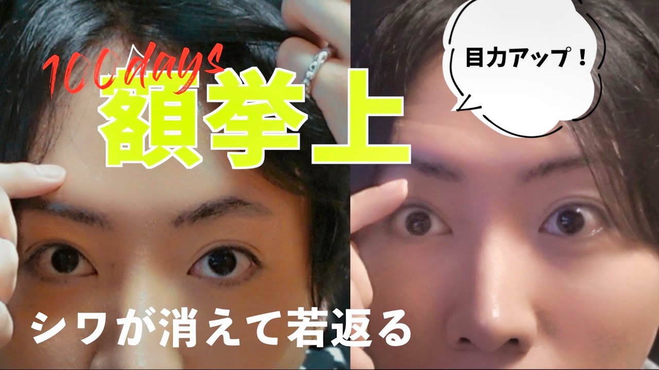 【dt経過】額挙上手術の経過を報告します【30代アンチエイジング】