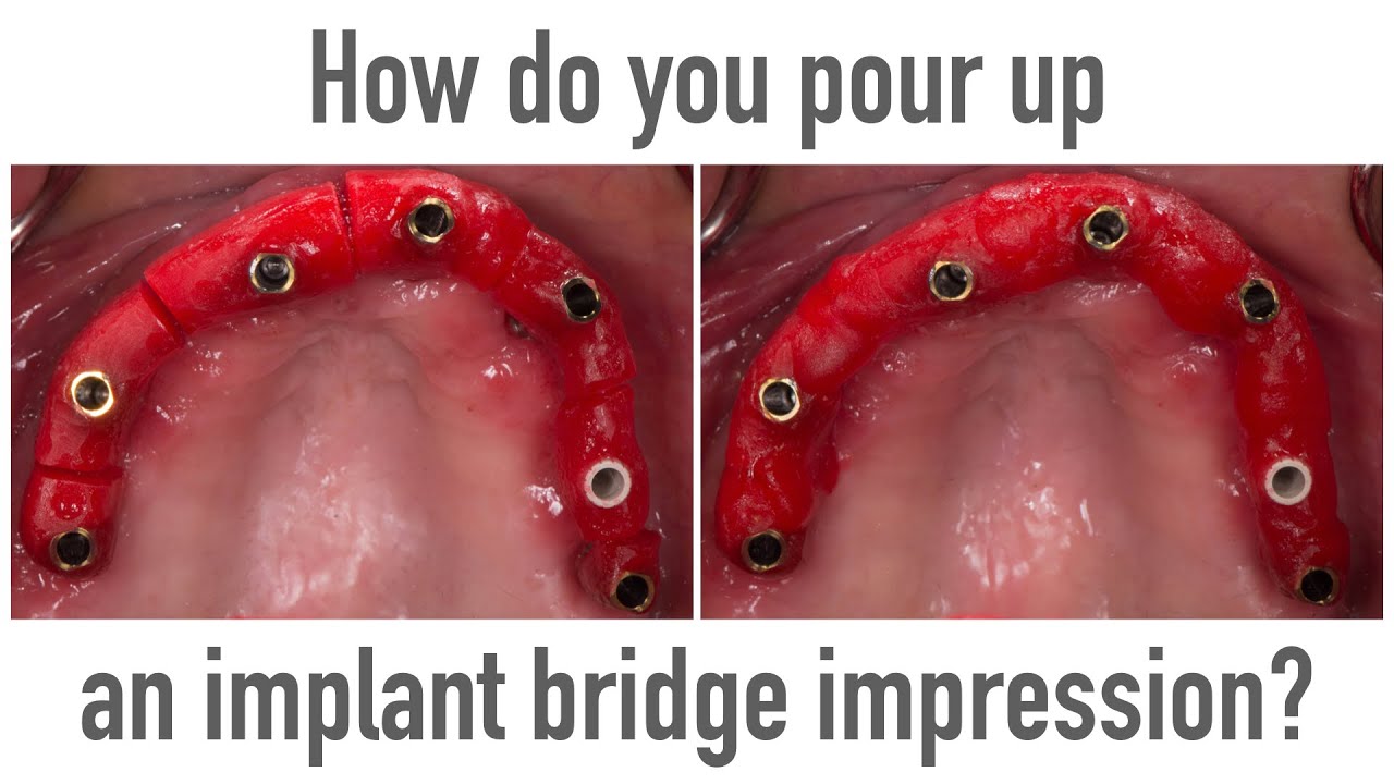 How to pour up an implant bridge impression for passive fit?