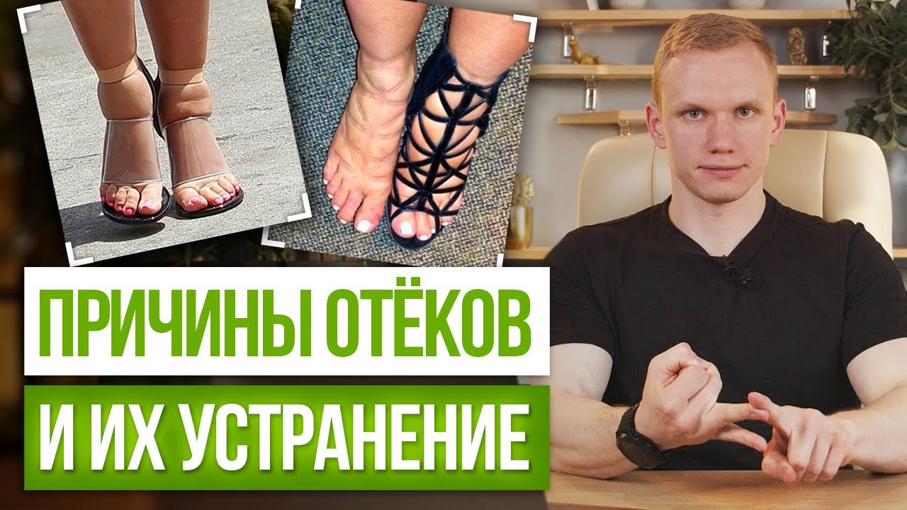 Почему появляются отёки? / Как быстро убрать опухлость лица и снять очень сильные отеки?