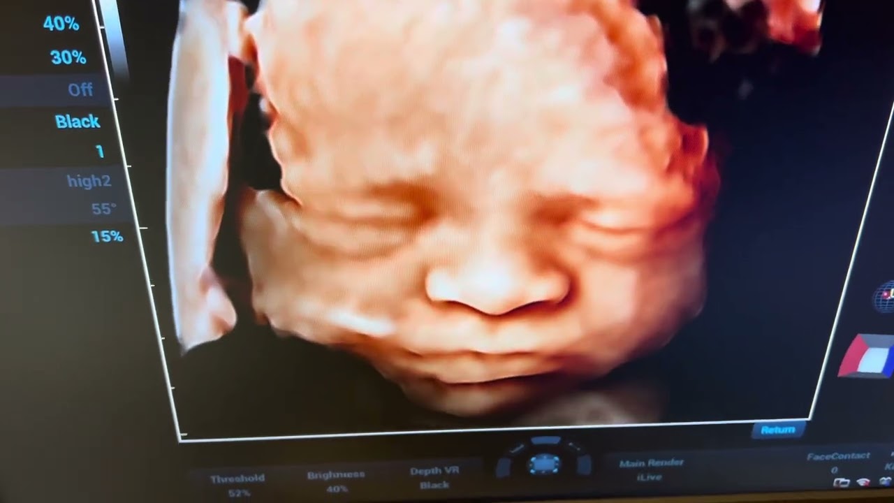 4D ultrasound